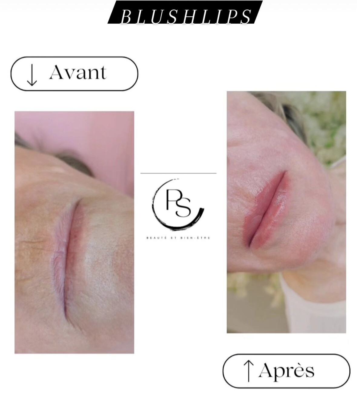Contour redessiné — pigmentation des lèvres par Le Pouvoir De Soi